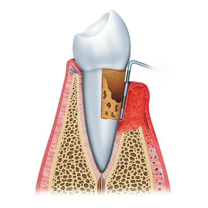 Parodontite sévère<br/>Phase terminale
