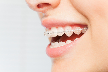 Des bagues presque invisible ? C’est possible !
