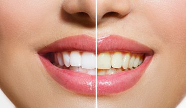 Les dernières dents à venir complèter la denture humaine sont les dents de sagesse. Elles se font généralement remarquer à l’approche de la vingtaine. Le médecin-dentiste est la personne la mieux placée pour décider s’il faut les extraire et quand les extraire.