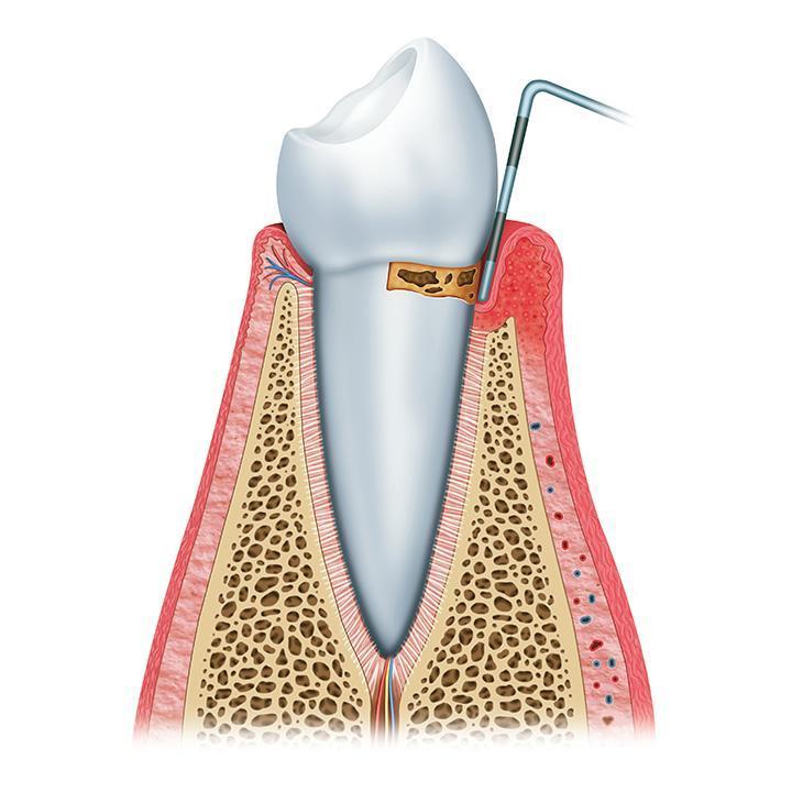 Parodontite débutante<br/>Début de destruction osseuse
