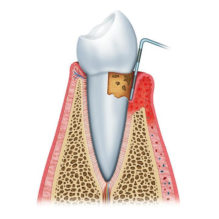 Parodontite modérée<br/>Destruction osseuse avancée
