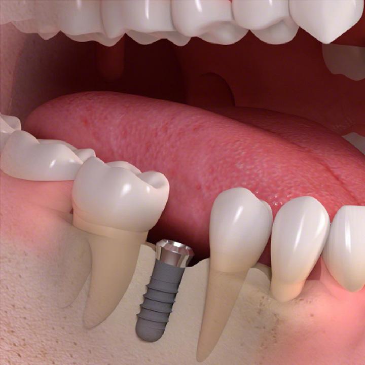 dentiste-chablais-article-implant-dentaire-03