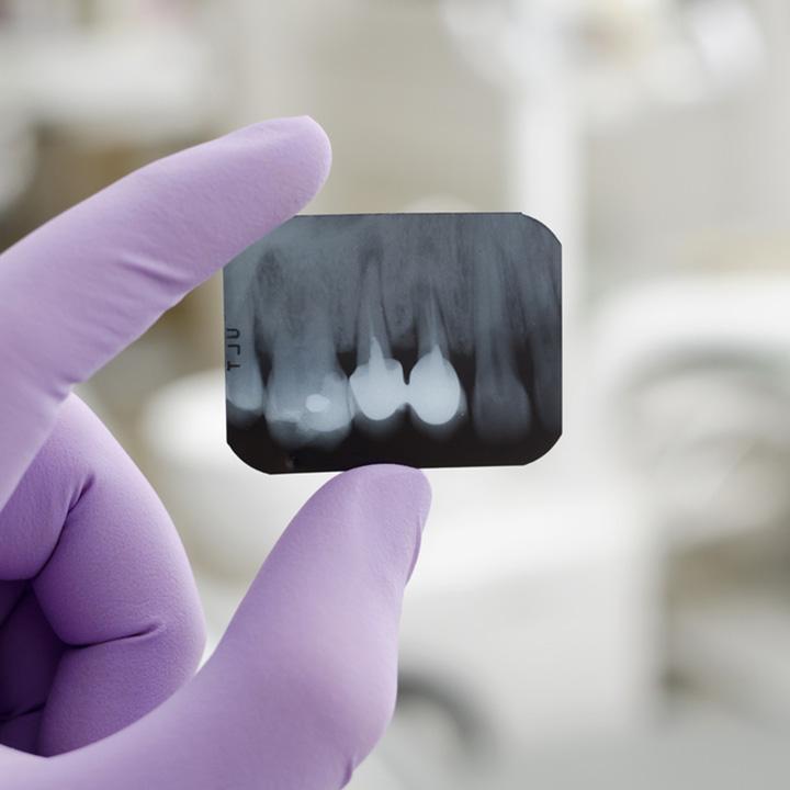 dentiste-chablais-article-implant-dentaire-05
