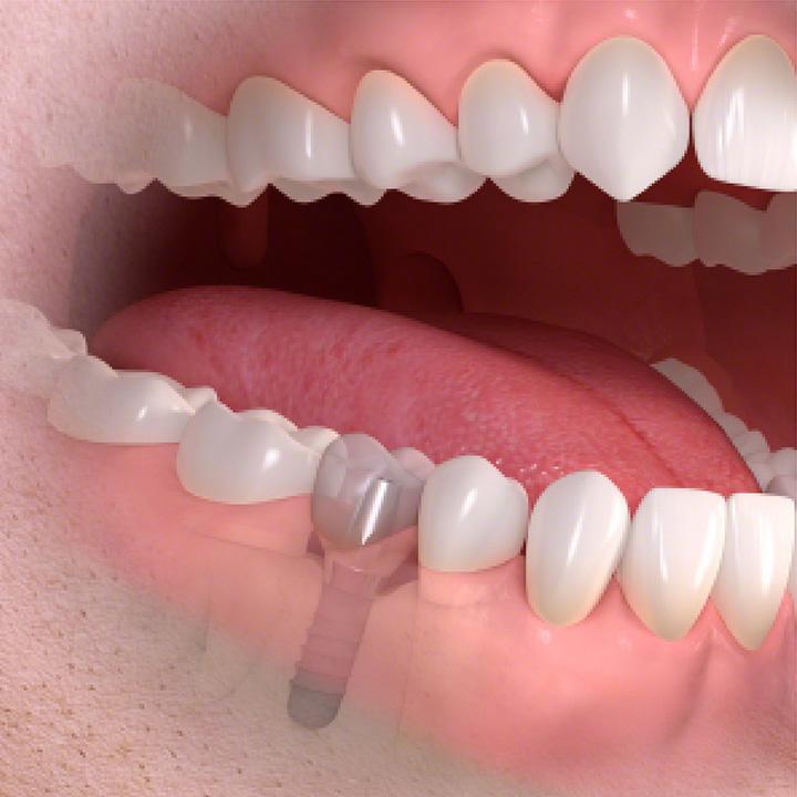 dentiste-chablais-article-implant-dentaire-08