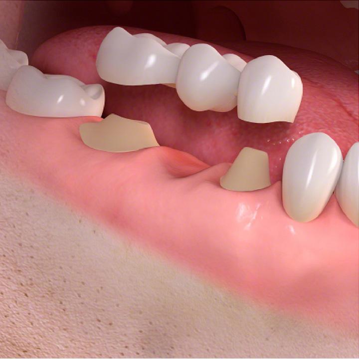 dentiste-chablais-article-implant-dentaire-09
