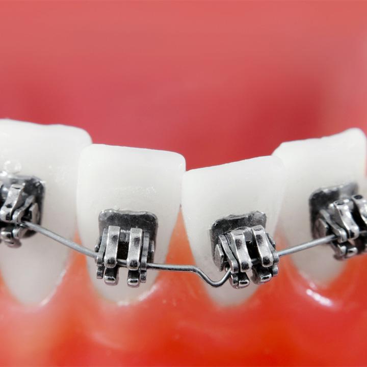 dentiste-chablais-article-orthodontie-enfants-et-adultes-04