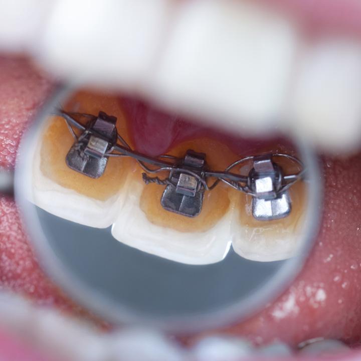 dentiste-chablais-article-orthodontie-enfants-et-adultes-05
