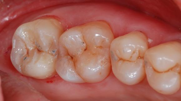 Scellements de fissure ou sealing qu’en est-il ?